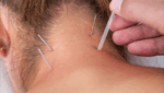 Dry Needling a woman's neck