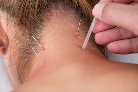 Dry Needling a woman's neck